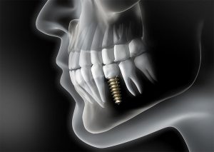 Implantatgetragener Zahnersatz - Zahnärzte Schwarzer - Sann in Castrop-Rauxel Ickern